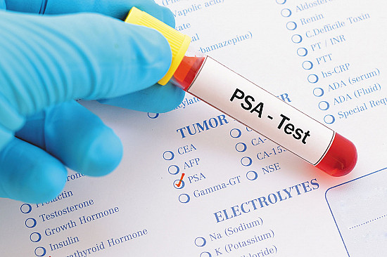 Older men continue to have excessive PSA testing featured image