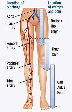 Peripheral artery disease: An update featured image