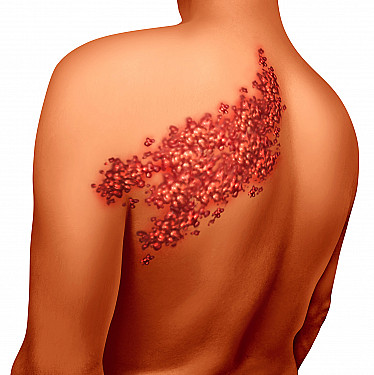 Celebrities get shingles, too featured image